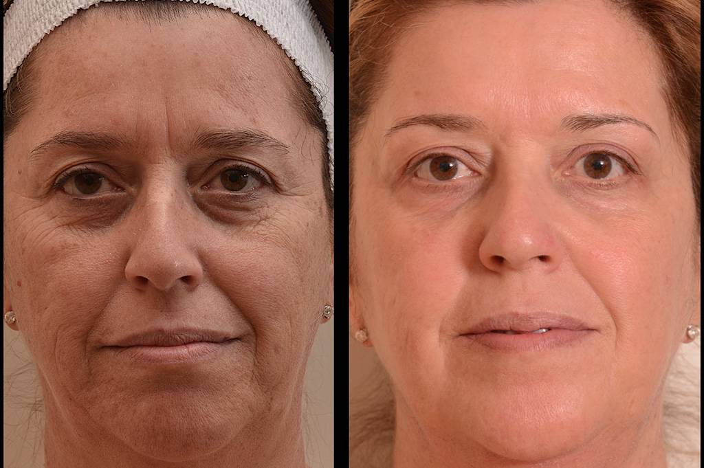 Уход за кожей лица после 40 - антивозрастной уход | клиника "отражение"