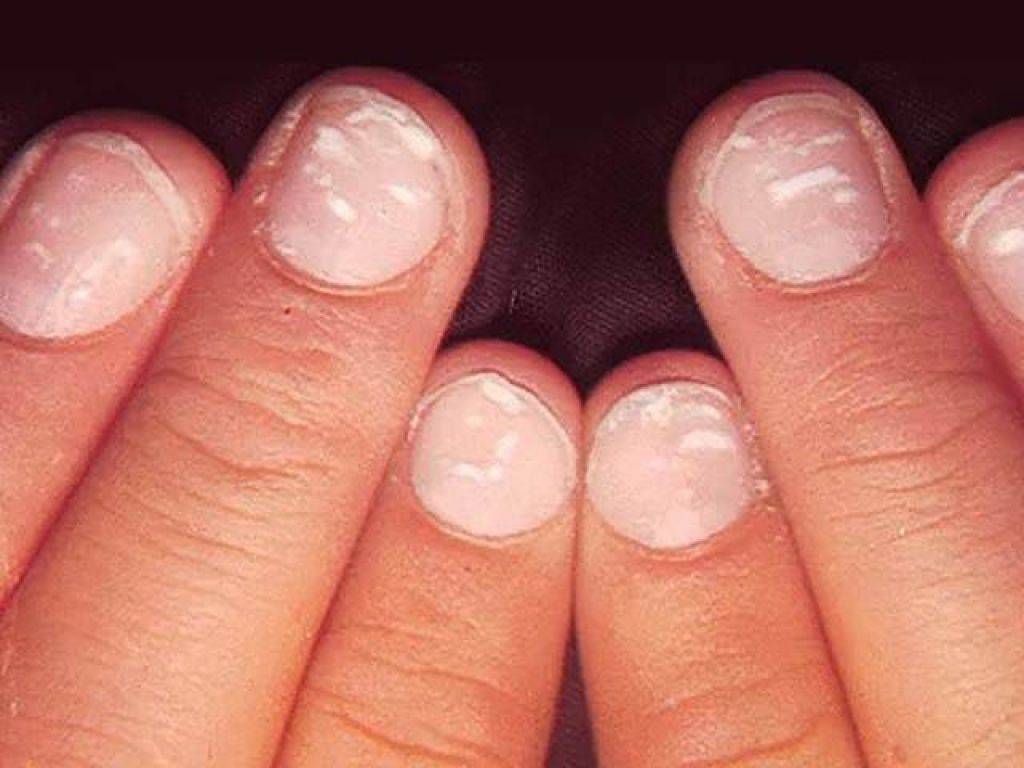 Темное пятно на ногте большого пальца ноги - причины появления, диагностика и методы лечения