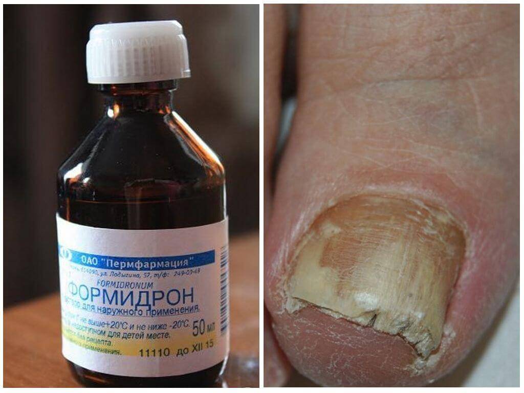 Прополис от грибка ногтей