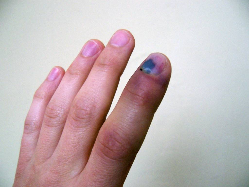 Синеют ногти на руках и ногах: причина, что делать, как правильно лечить