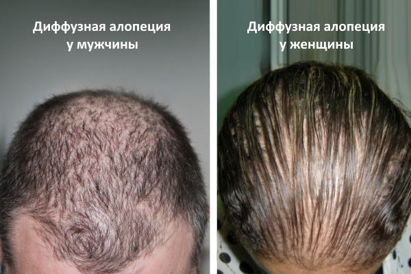 Алопеция: причины, типы выпадения волос, анализы, методы лечения