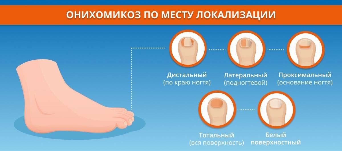 Лечение грибка ногтей. как будут выглядеть ногти после процедуры?