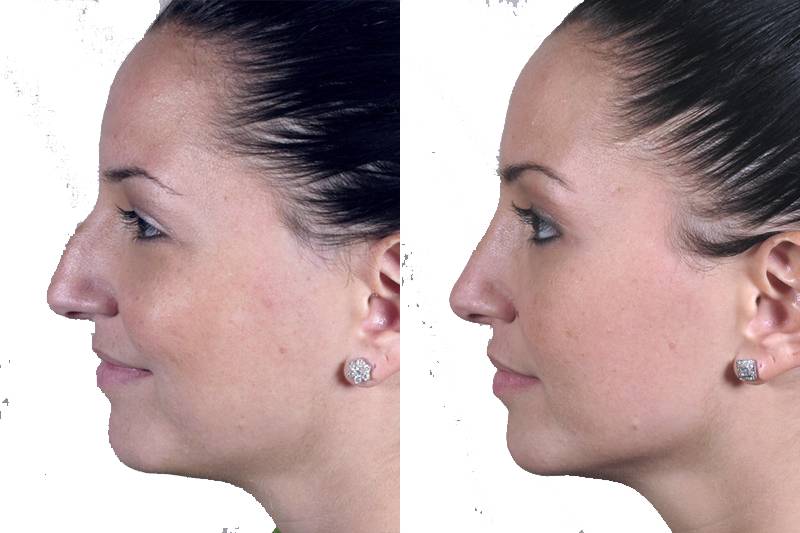 Нос с горбинкой: почему появляется, как убрать, как скрыть, коррекция без операции и ринопластика