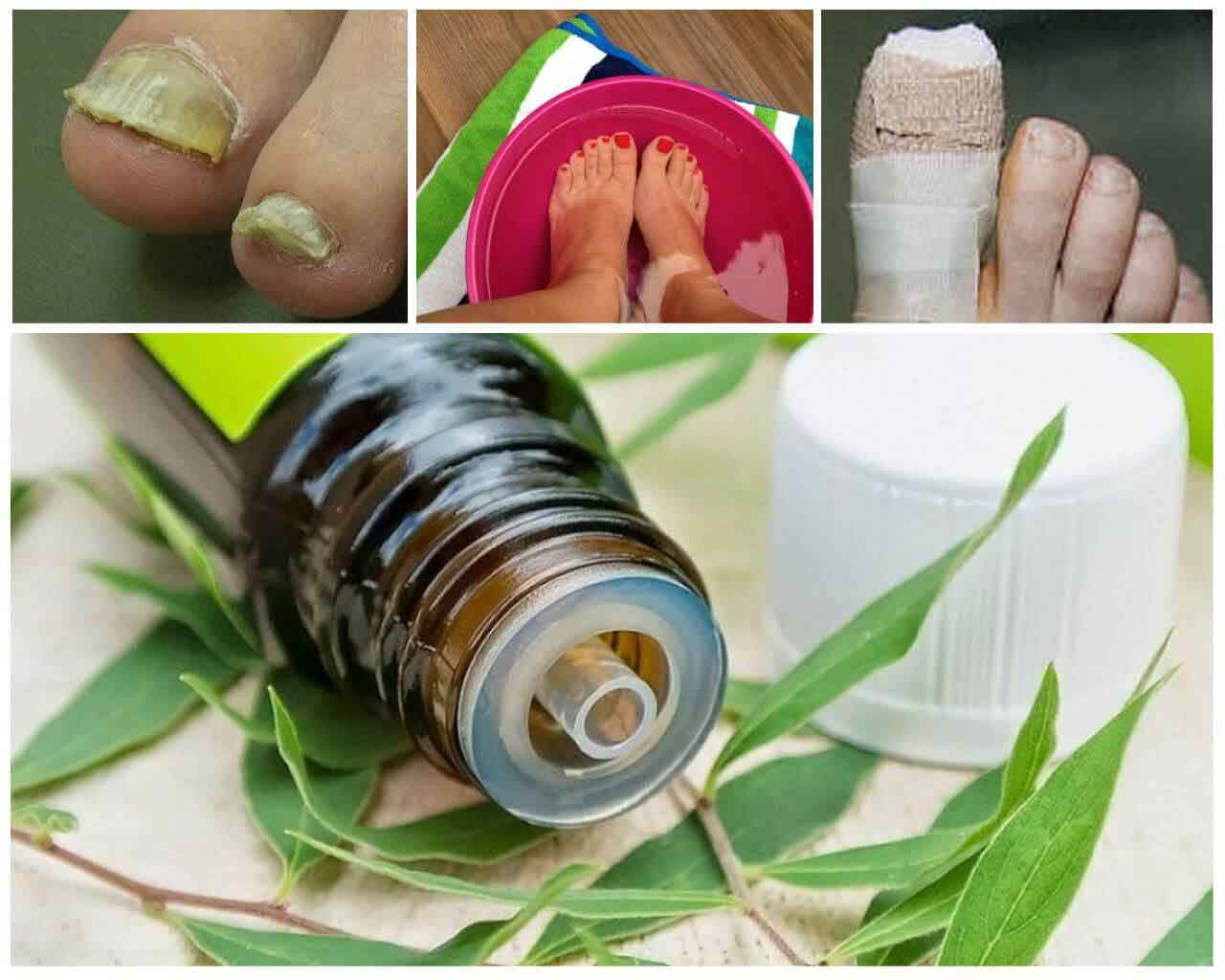 Эфирные масла от грибка ногтей на ногах: перечень эффективных, инструкция, отзывы