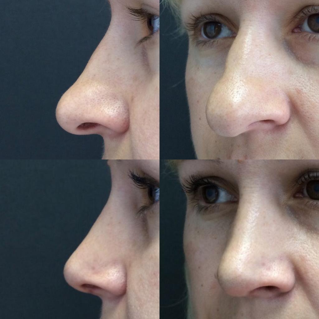 Пластика носа (ринопластика): стоит ли делать? - клиника в уручье