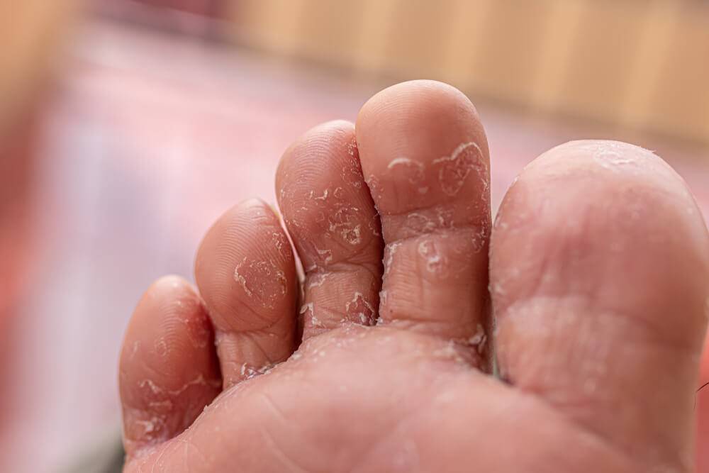 Почему слезает кожа между пальцами ног