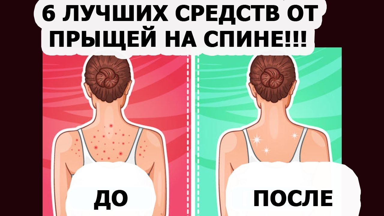 Как избавиться от прыщей на спине и плечах в домашних условиях быстро | afrodita-spa.ru