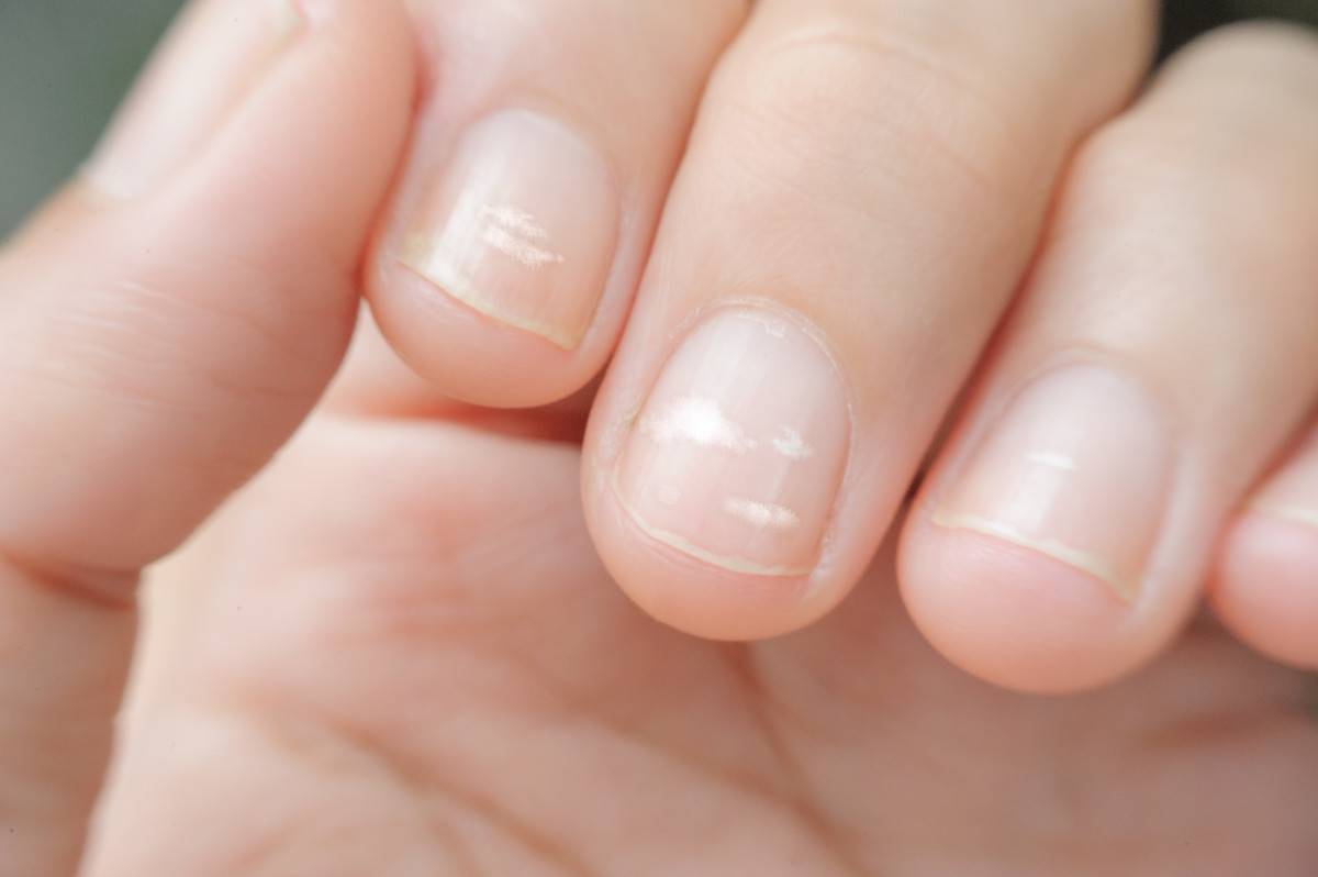 Почему появляются белые пятна на ногтях пальцев рук - причины, как избавиться - medside.ru