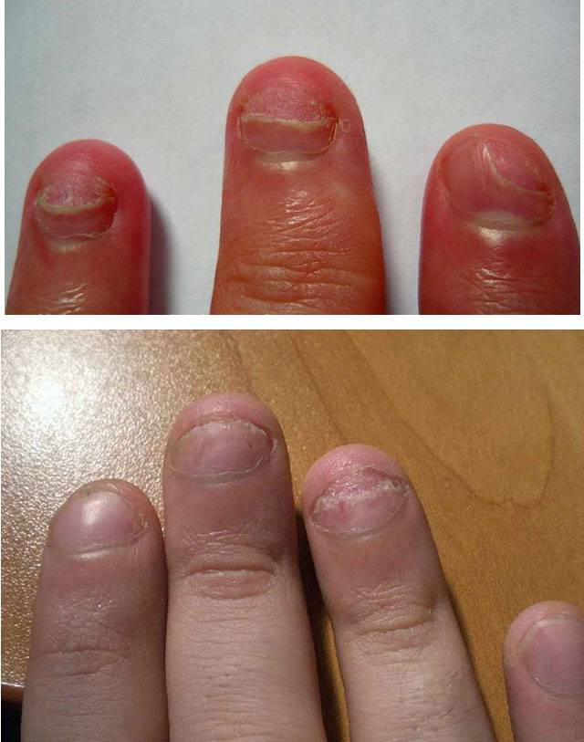 Лечение атрофии ногтей на руках: основные этапы | красивые ногти - дополнение твоего образа