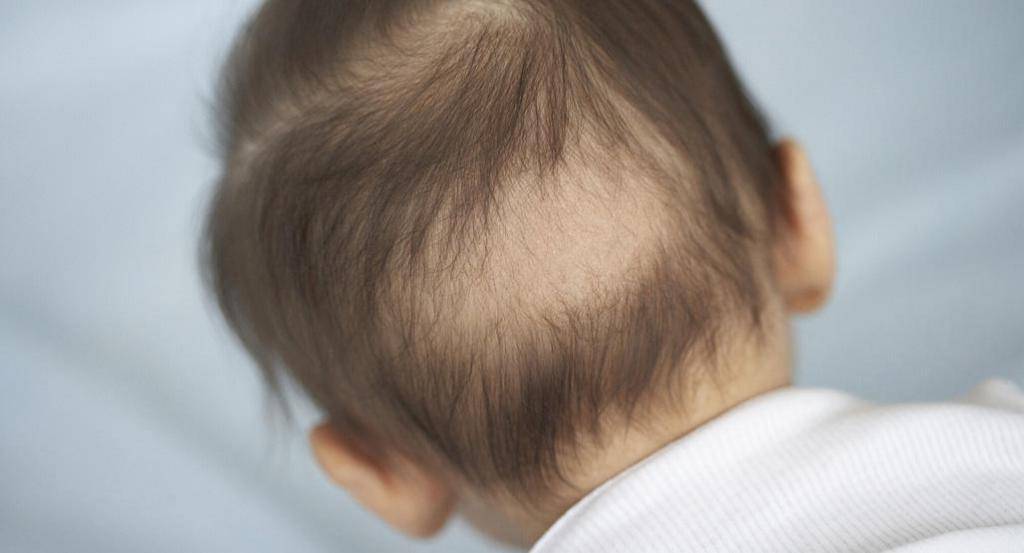 Алопеция у детей, причины облысения у подростков - клиника «доктор волос»