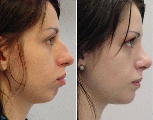Макияж, хирургия и косметология: как лучше убрать горбинку на носу?