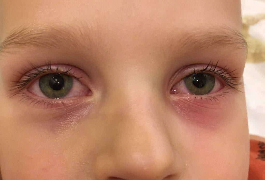 У ребенка красное под глазами: причины и что делать