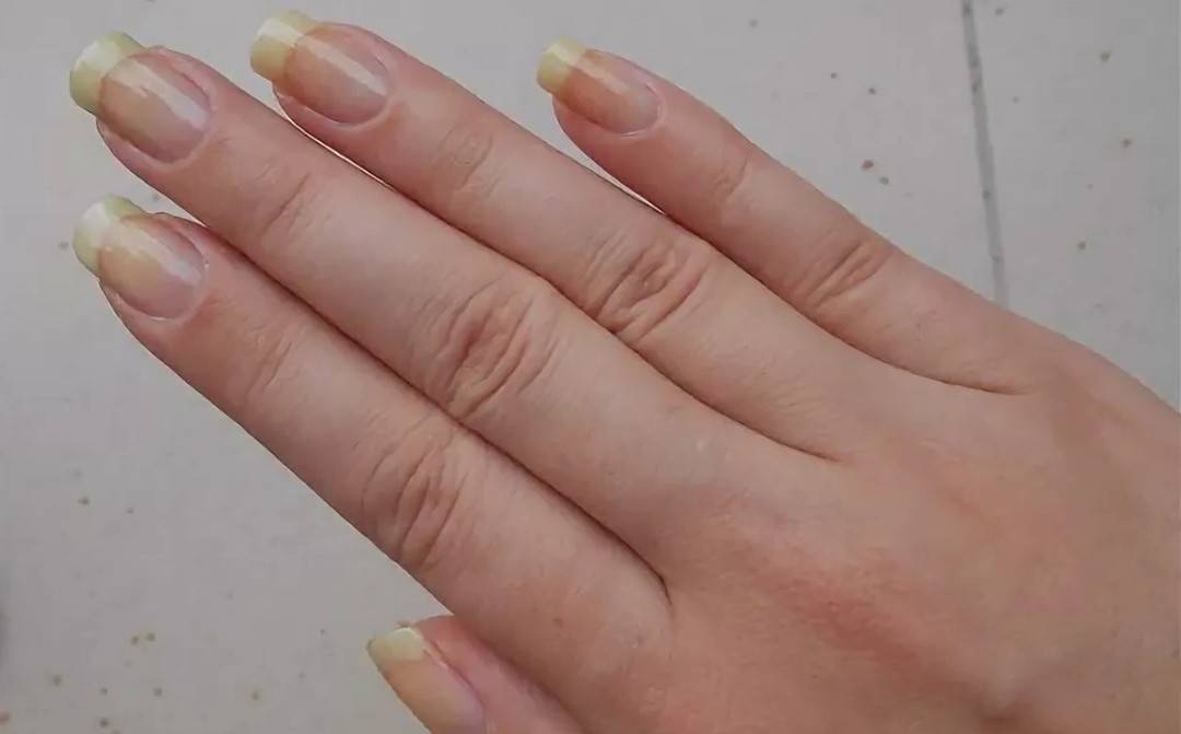 Причины желтизны ногтей и лечение