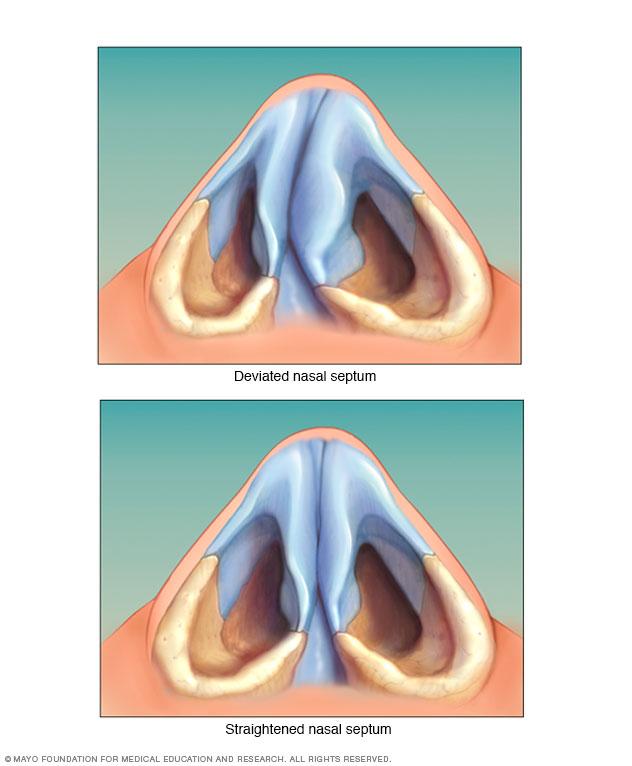 Септопластика: операции на носовой перегородке, как проходит коррекция и исправление носа