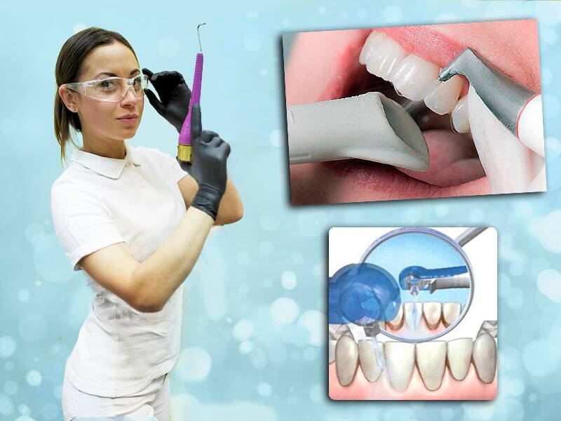 Чистка зубов от зубного камня | удаление камня ультразвуком