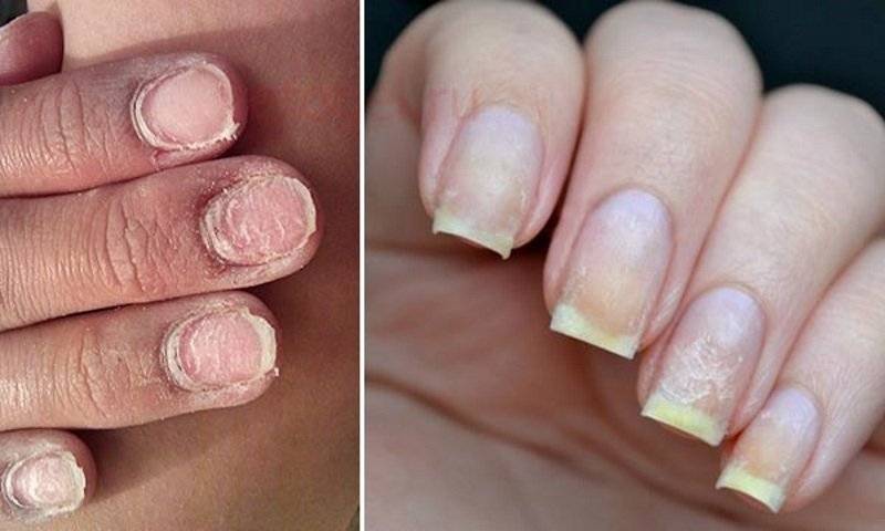 Что происходит с ногтями после наращивания: вред от процедуры