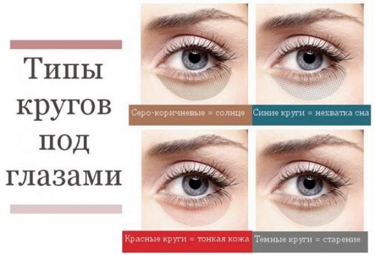 Как избавиться от синяков под глазами в домашних условиях