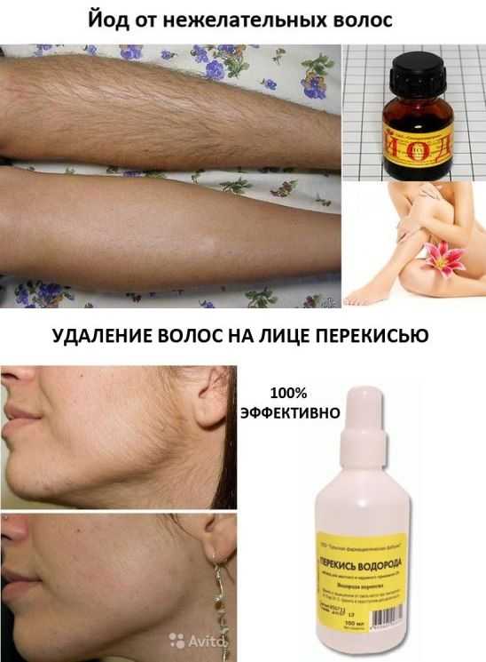Как удалить волосы на лице навсегда