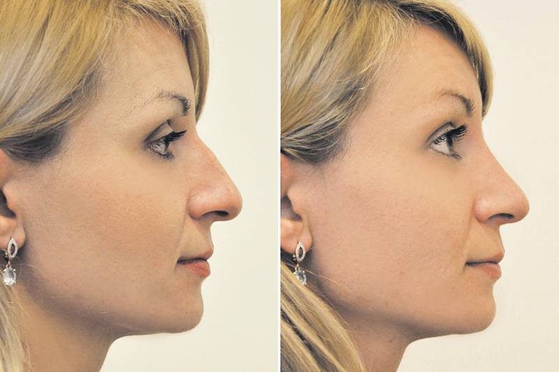 Микроринопластика – новое направление в пластике носа