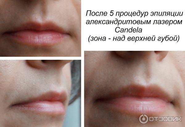 Усики над губой у женщин — почему растут волосы над губой и как от них избавиться