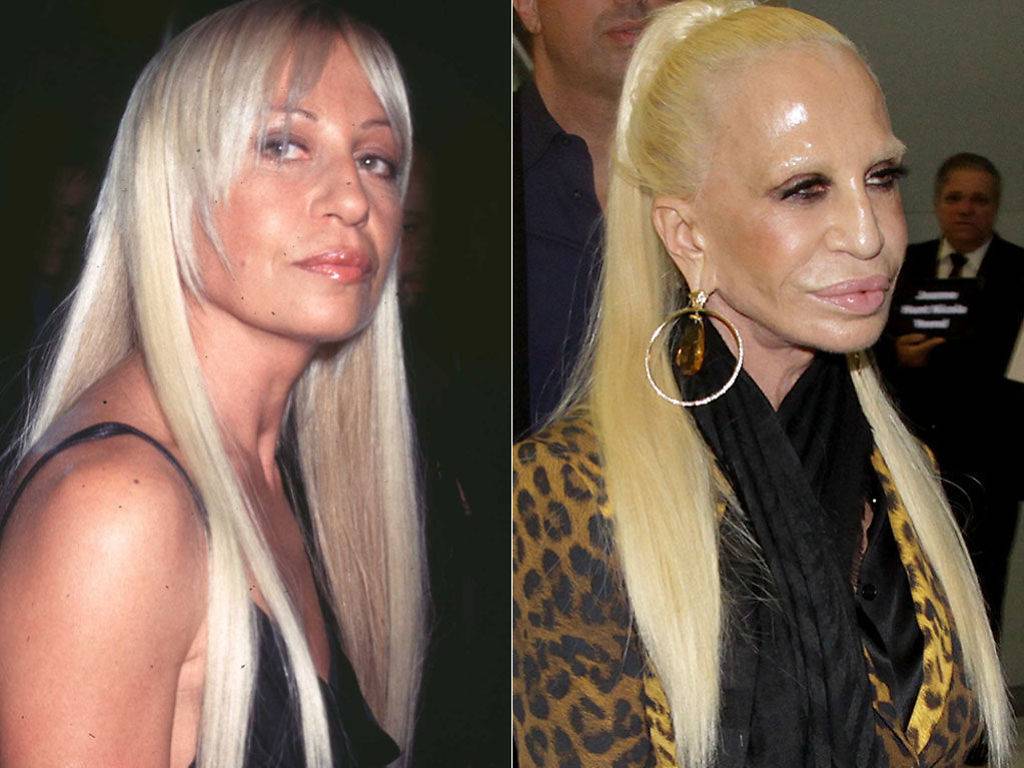 Донателла версаче до операций фото. Donatella Versace до пластики. Донателла Версаче пластикм. Донателла Версаче пластика. Донателла Версаче до операции.