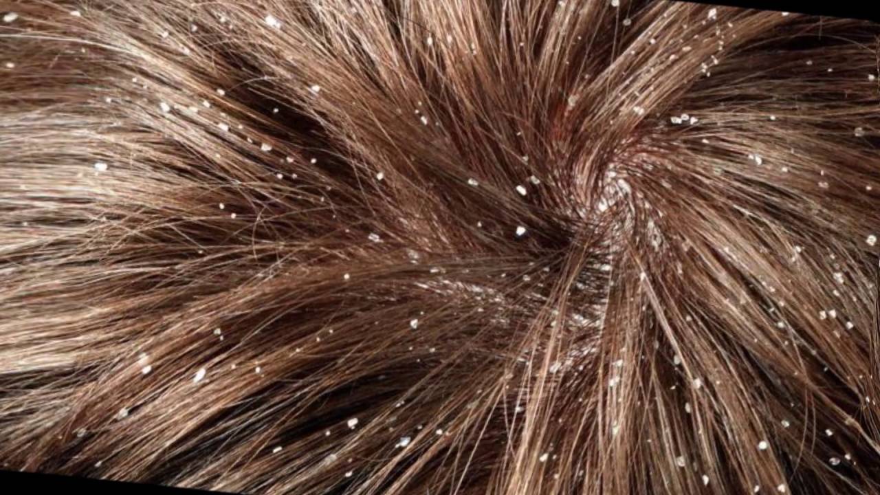 Как отличить перхоть от гнид на волосах – методы, позволяющие не путать гнид с перхотью