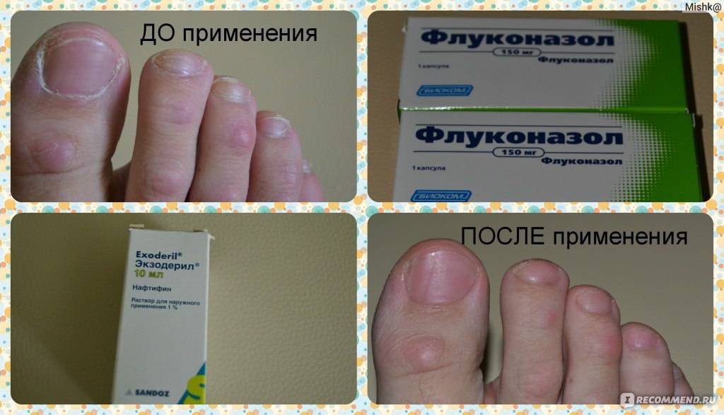 Грибок ногтей на ногах: симптомы, причины появления, методы лечения и профилактики заболевания, факторы риска