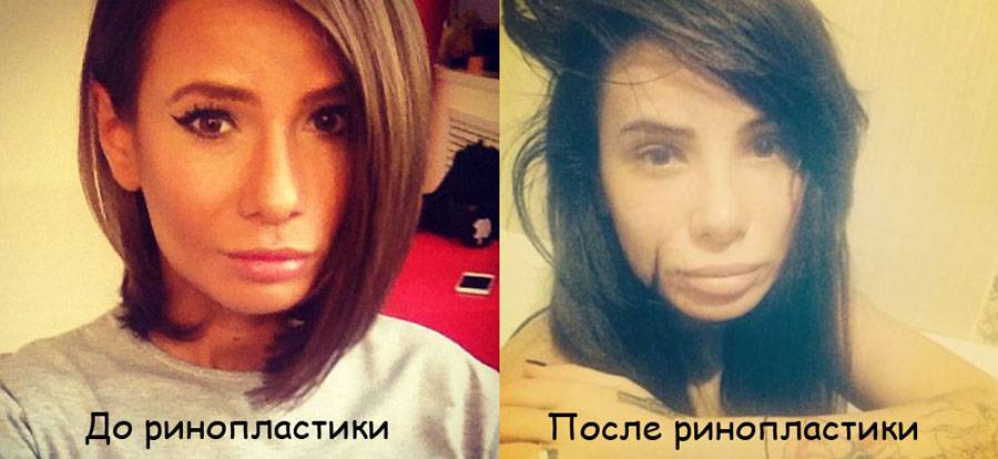 Айза До Операции Фото