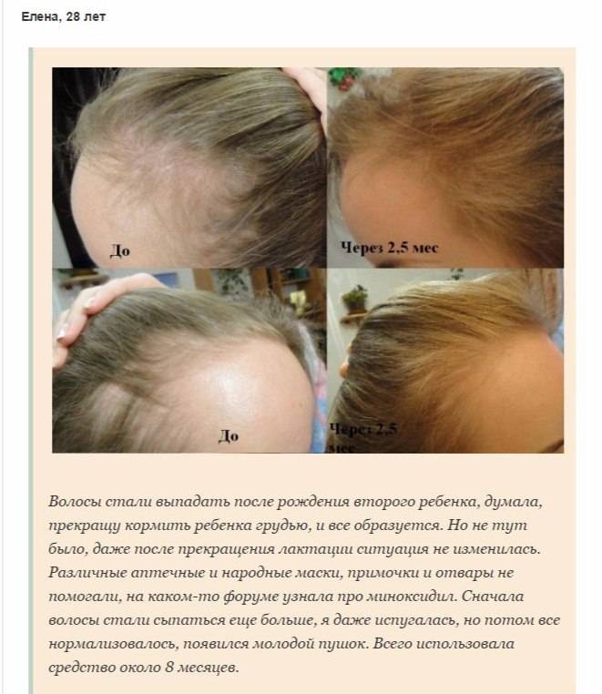 Спрей alerana 5 % против выпадения волос ‒ описание и применение