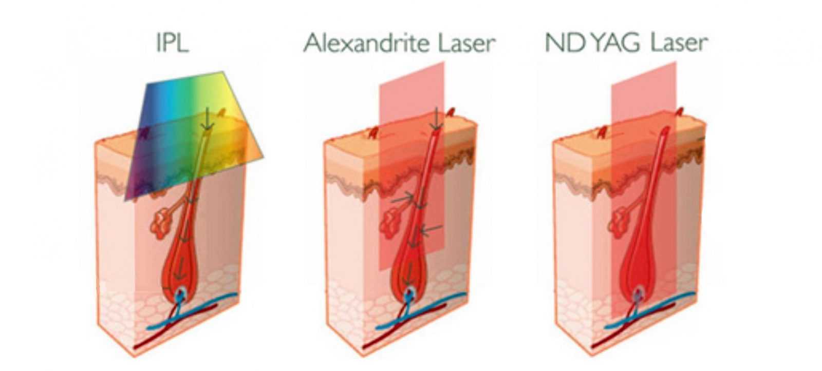 Чем отличается александритовый лазер от диодного. Диодный лазер для эпиляции схема. Глубина воздействия лазера для эпиляции. Параметры диодного лазера для эпиляции. Принцип работы диодного лазера для эпиляции.