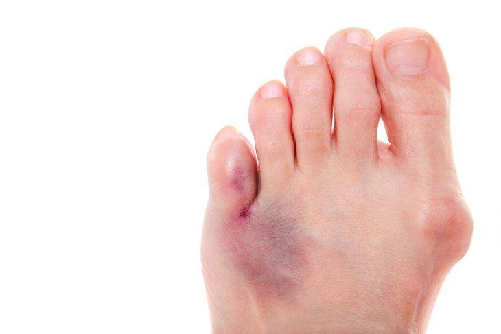 Симптомы и лечение ушиба пальца на ноге