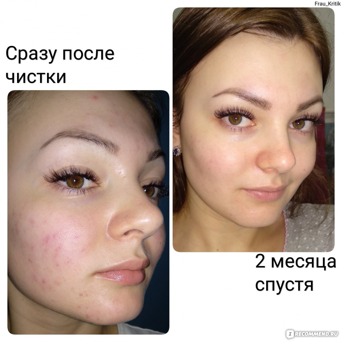 Ультразвуковая чистка лица: фото до и после, отзывы пациентов - idealplastic.ru