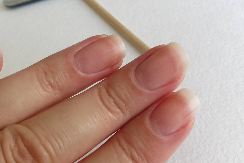 Почему ломаются ногти: определение причины и способы ее устранения