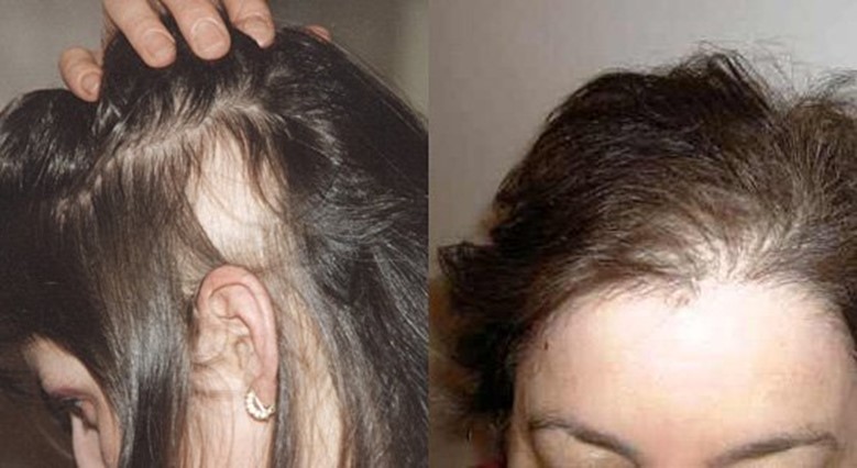 Посчитаемся: причины выпадения волос
