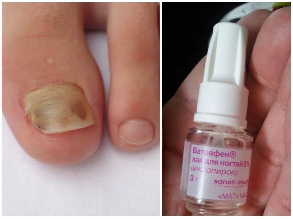 Как действуют лаки от грибка на ногтях?