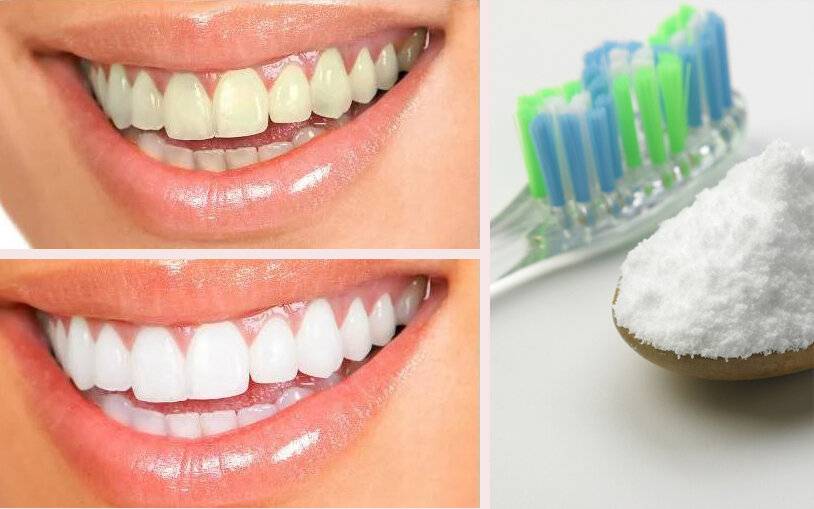 безопасные способы отбеливание зубов в домашних условиях