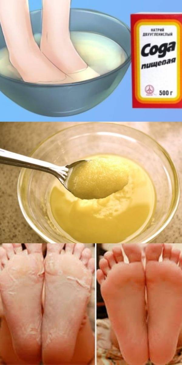 Как очистить огрубевшие пятки?