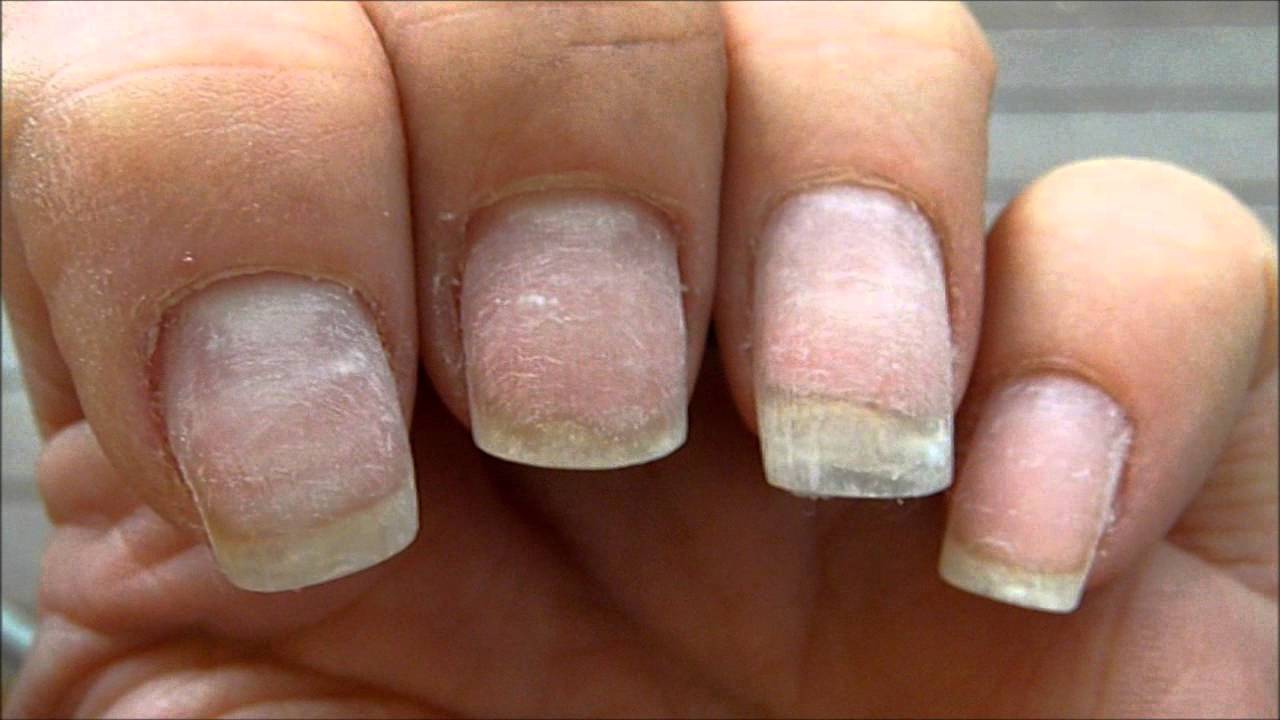 Как восстановить ногти после гель-лака, укрепить ногти после гель-лака (быстро), вылечить ногтевую пластину (ухаживать)