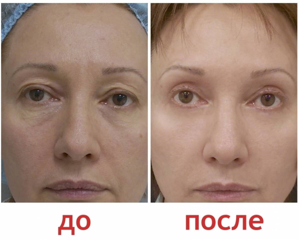 Безоперационная блефаропластика: методы подтяжки век без операции