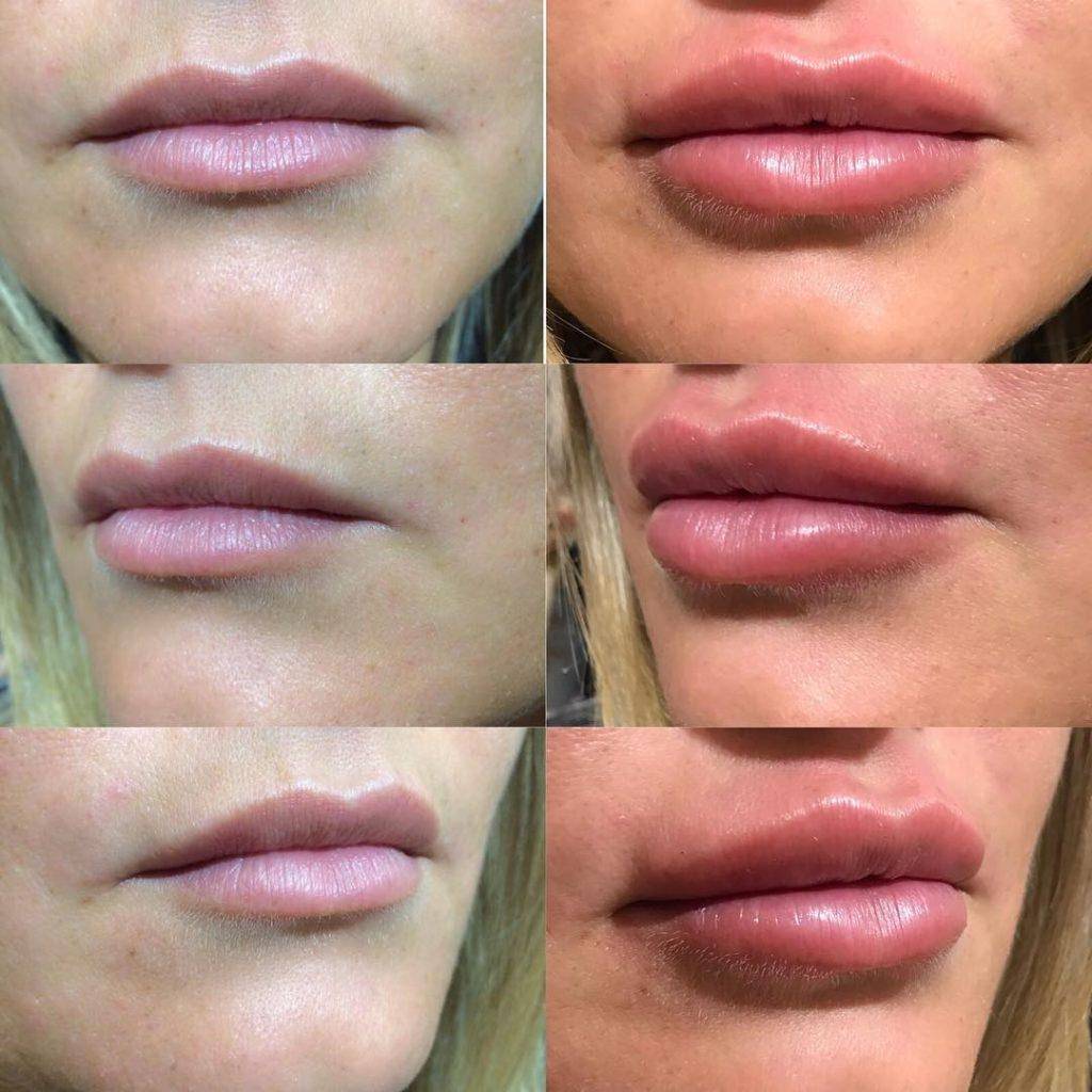 Увеличение губ: плюсы и минусы | часто задаваемые вопросы об инъекционной косметологии