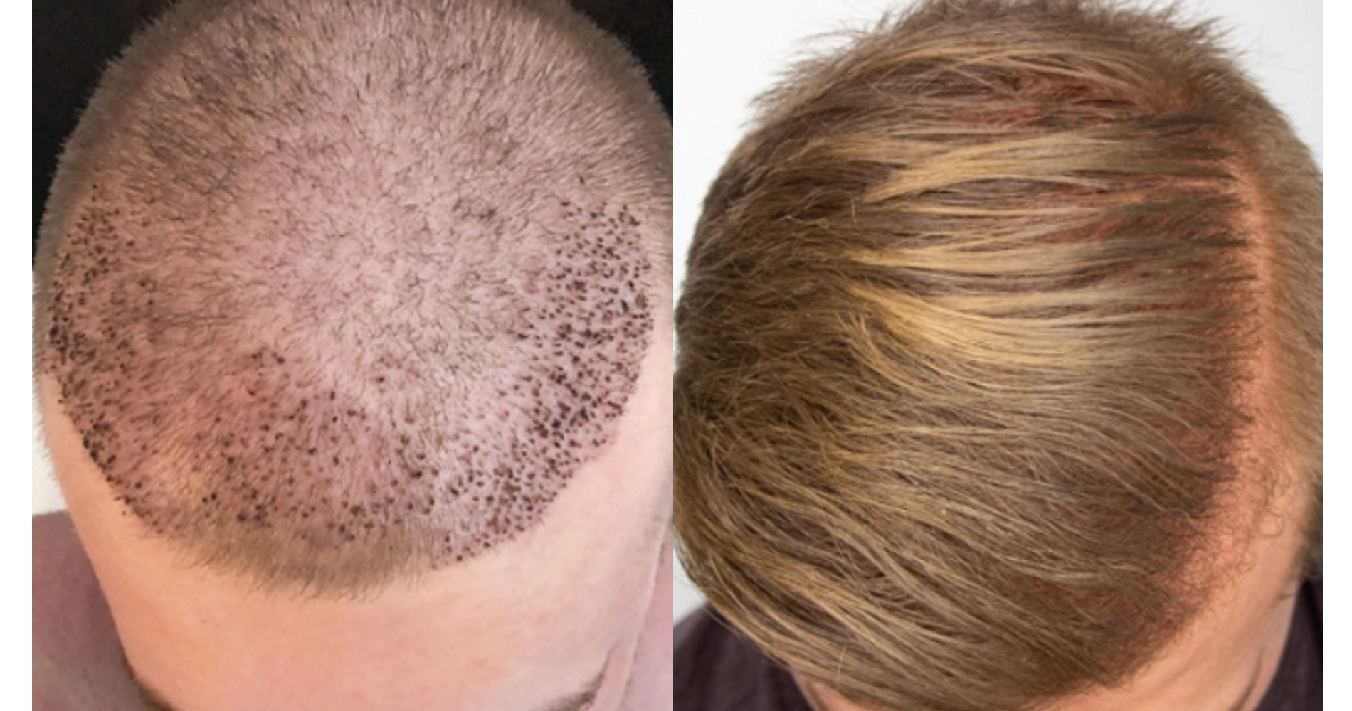 Пересадка волос: плазмолифтинг до и после пересадки волос - косметология доктора корчагиной