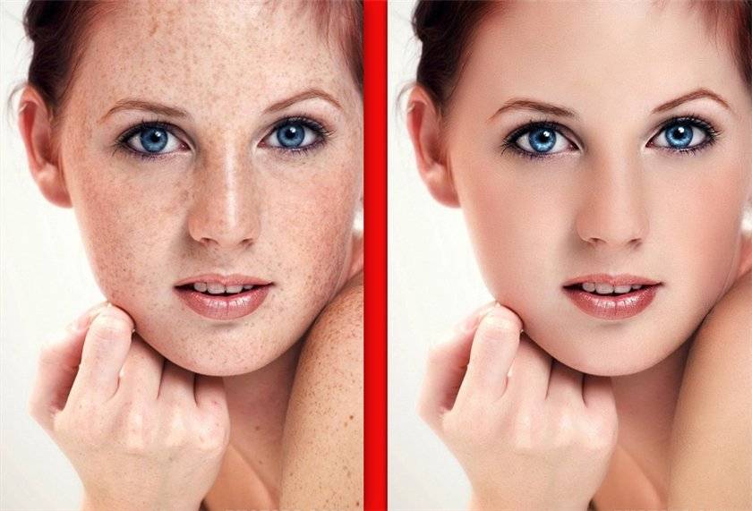 Как удалить пигментные пятна на лице с помощью косметических средств и аппаратной косметологии