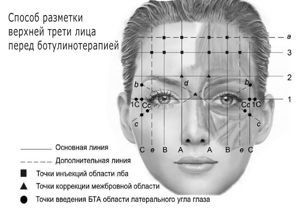 Мезоботокс схема разведения и введения