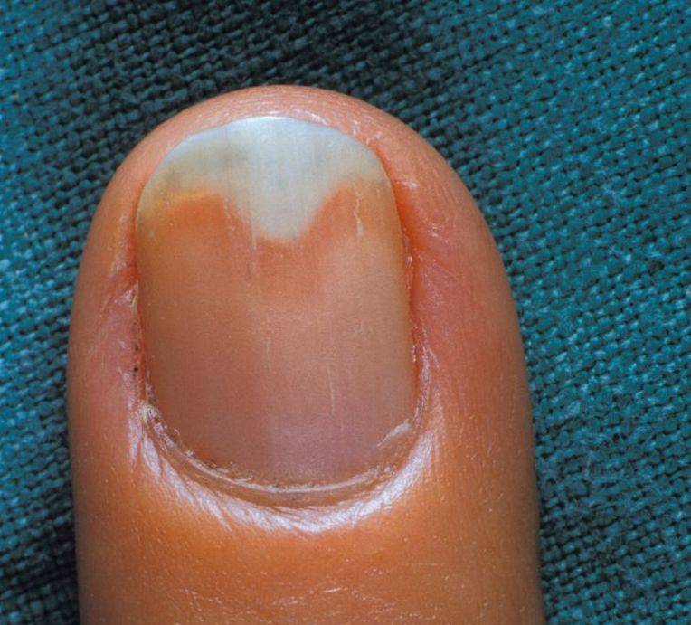 Что делать, если отошли ногти после снятия гель-лака
