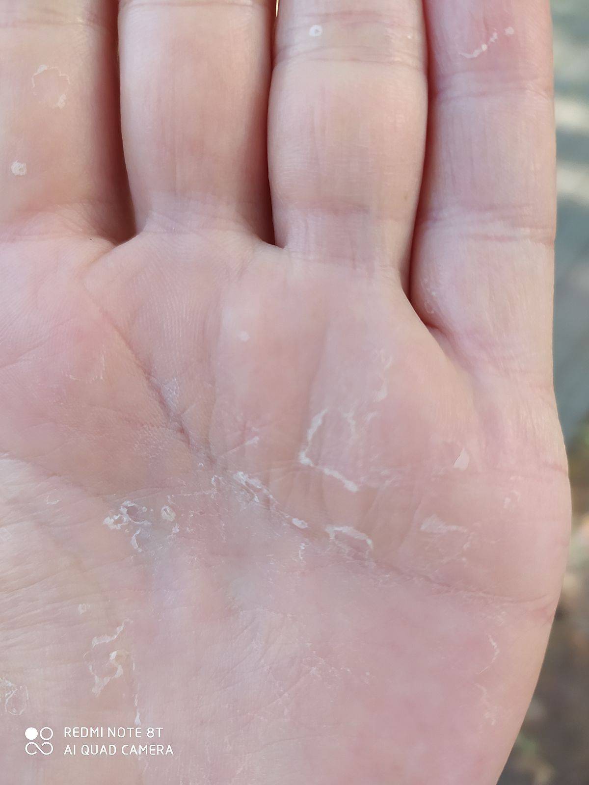 Почему шелушится кожа на руках, ногах и других частях тела
