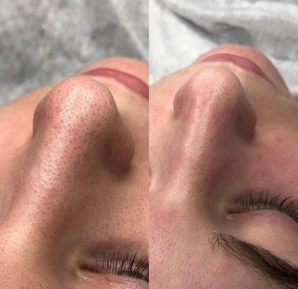 Чистка лица у косметолога фото до и после фото