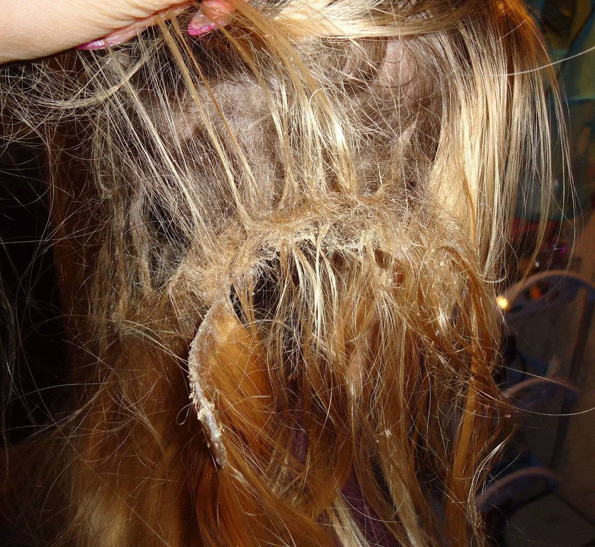 Наращивание волос после травмы