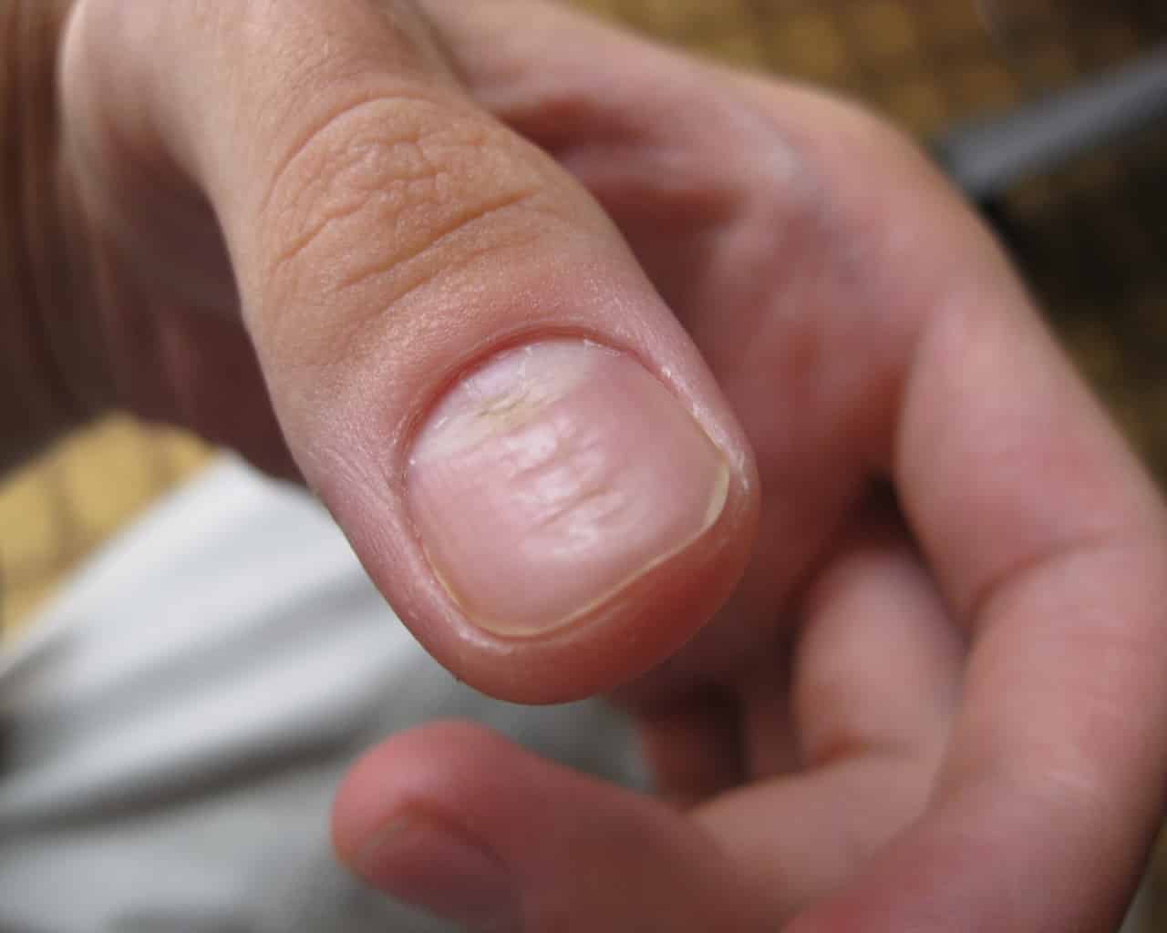 Ониходистрофии — симптомы и способы лечения грибка ногтей в клинике целт