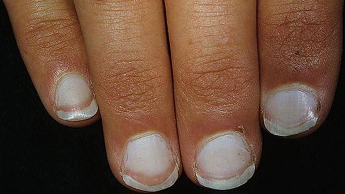 Оценка линий ногтей: цвет и вид - ключи к диагностике | дерматология в россии