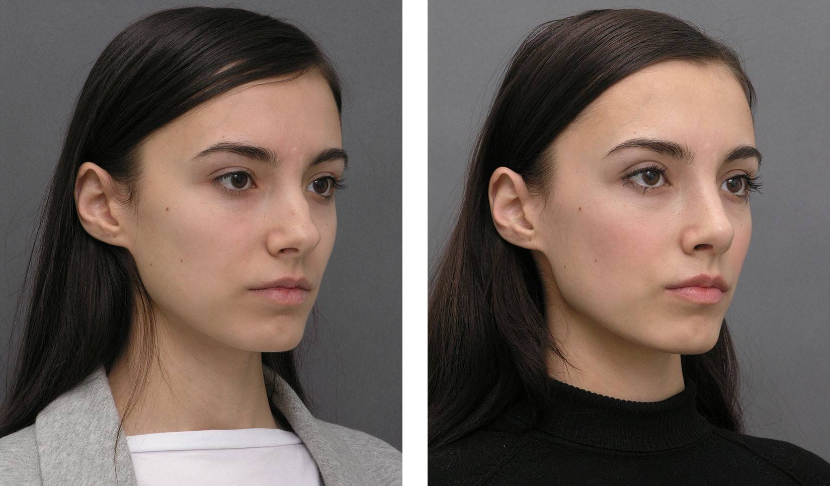 Коррекция носа филлерами: фото до и после, а также аспекты процедуры